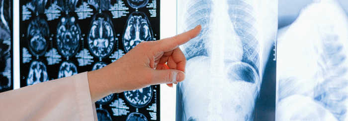 CUORE E POLMONI: COME SONO COLLEGATI E COME INCIDE LO SCOMPENSO CARDIACO