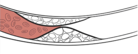 Colesterolo LDL arteria ostruita