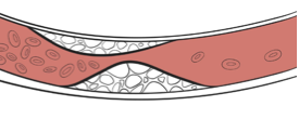 Ostruzione arteria colesterolo LDL