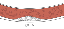 placca aterosclerotica colesterolo LDL